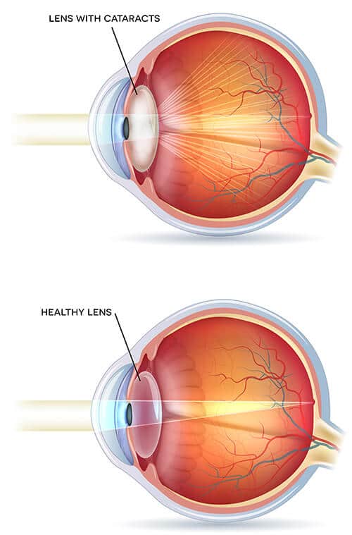 Chart illustrating an eye with a healthy lens vs one with a cataract