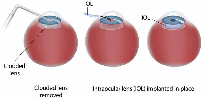 Cart illustrating the cataract surgery process