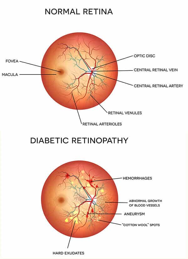 Chart Illustrating a Normal Retina vs One Experiencing Diabetic Retinopathy