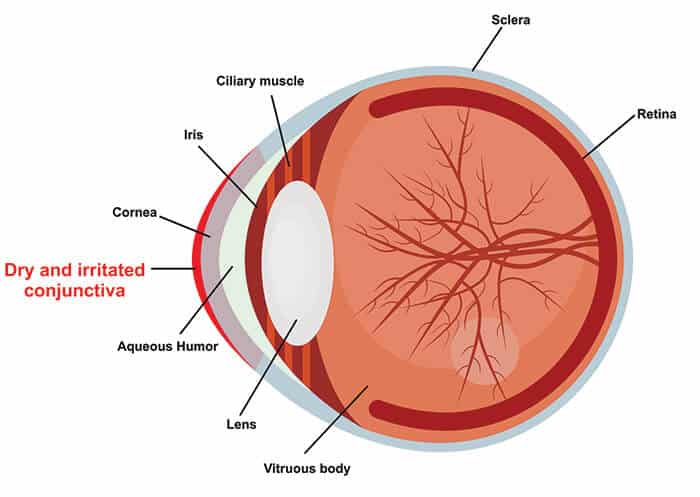 Chart illustrating how dry eye affects an eye